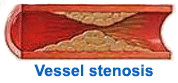 Vascular stenosis